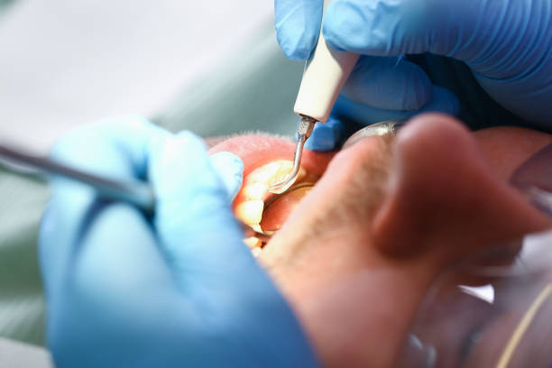 Best Emergency Root Canal Treatment in Carlton, OR